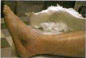 The image displays a photograph of an ice pack being applied to a person's lower leg and ankle.